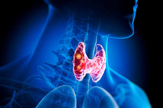 بیماری گریوز (Graves Disease) 